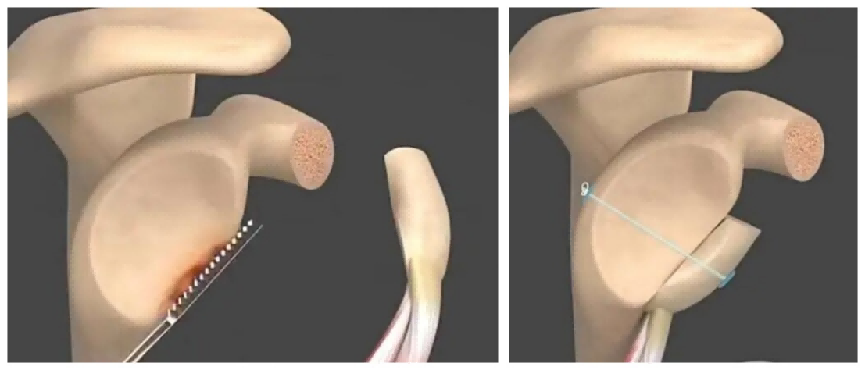 深圳医生两小时“驯服”法国奶爸多年旧伤905