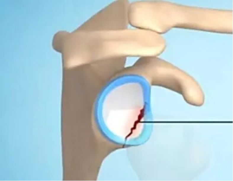 深圳医生两小时“驯服”法国奶爸多年旧伤585